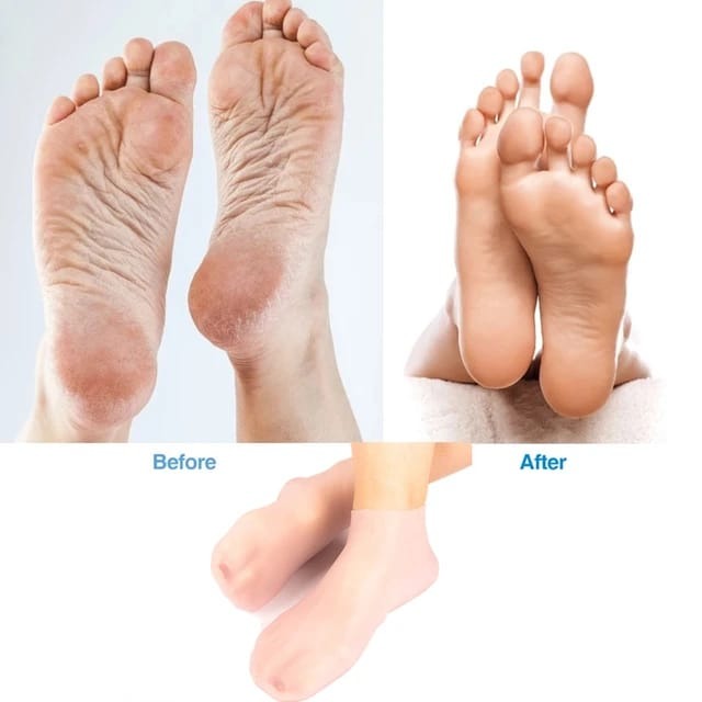 1 Pair Silicone Moisturizing Gel Foot Care Socks For Cracked Heels & Dry Skin Repair - Image 5